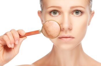 How To Get Rid of Melasma How To Get Rid of Melasma