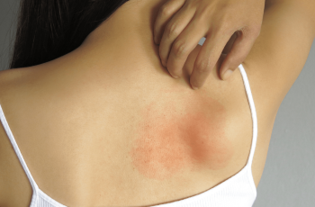 Skin Allergy Symptoms, Diagnosis, Treatment & Management Skin Allergy Symptoms, Diagnosis, Treatment & Management