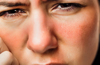 What Causes Sun Sensitivity or a Sun Allergy? What Causes Sun Sensitivity or a Sun Allergy?