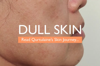 What is Dull Skin & What are the Causes?