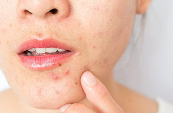 What Causes Acne? What Causes Acne?