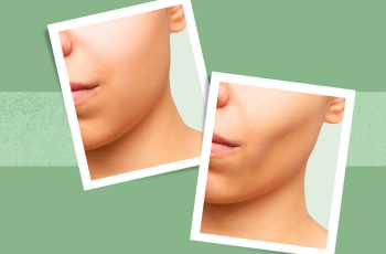‘Ozempic Face’: How Weight Loss Changes the Skin, and the Treatments That Can Helpp