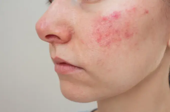 Understanding Rough, Bumpy Skin: Causes and Effective Treatments Understanding Rough, Bumpy Skin: Causes and Effective Treatments