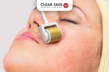 Revitalize Your Skin: Microneedling Rollers for Acne Scars Revitalize Your Skin: Microneedling Rollers for Acne Scars