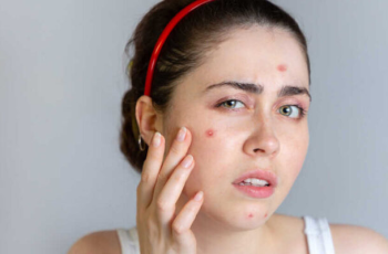 Should You Pop Your Pimple? A Dermatologist’s Guide to Skin Health Should You Pop Your Pimple? A Dermatologist’s Guide to Skin Health