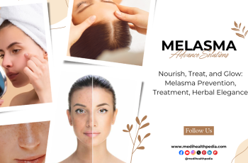 Understanding Melasma: Causes, Skincare Tips, and Treatment Solutions Understanding Melasma: Causes, Skincare Tips, and Treatment Solutions