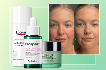 Expert Guide to Managing Rosacea: Skincare Tips, Treatments, and Remedies