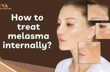 How to Treat Melasma Naturally and Get Even Skin