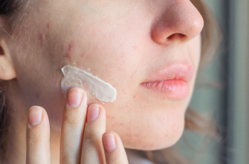 How Much Salicylic Acid Is Too Much for Skin?