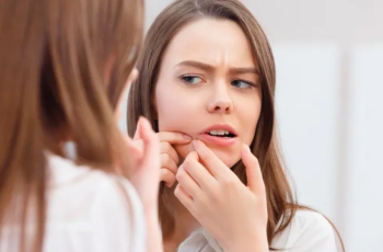 Cystic Acne Explained: Causes, Symptoms, Treatments, and Skincare Solutions
