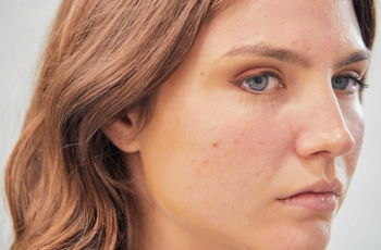 Blotchy Skin: What Causes It and How to Restore a Clear, Even Complexion