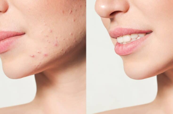 Fillers for Acne Scars: What You Need to Know