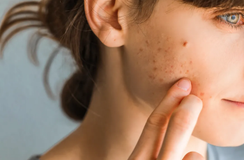 The Mood-Skin Connection: 5 Emotional Triggers That Affect Skin