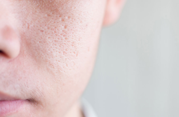 Causes and Treatments for Bumpy, Rough Skin: A Complete Guide